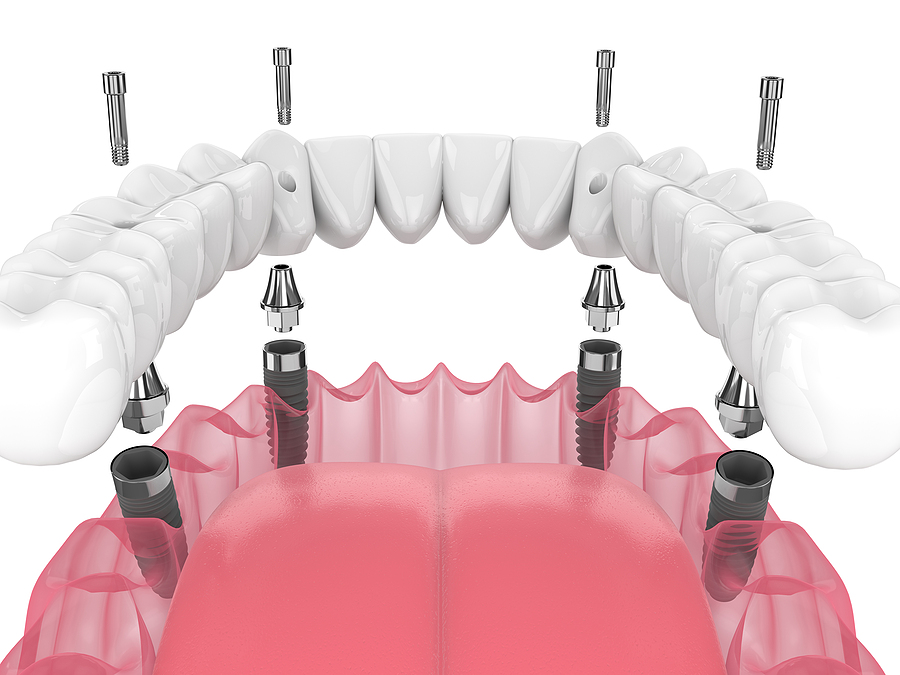 Regain Your Smile with All-on-4 Dental Implants in Houston, TX