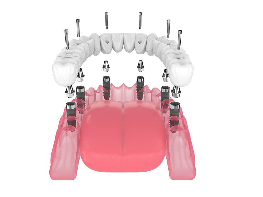 A Complete Guide to All-on-6 Dental Implants in Houston, TX