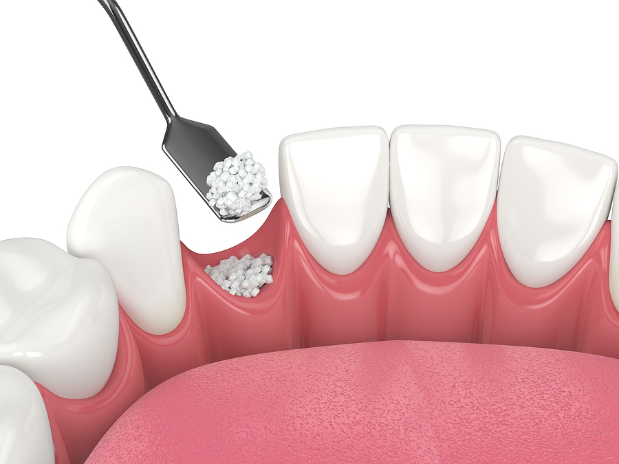 Enhancing Dental Health: A Comprehensive Guide to Bone & Sinus Grafting in Houston, TX