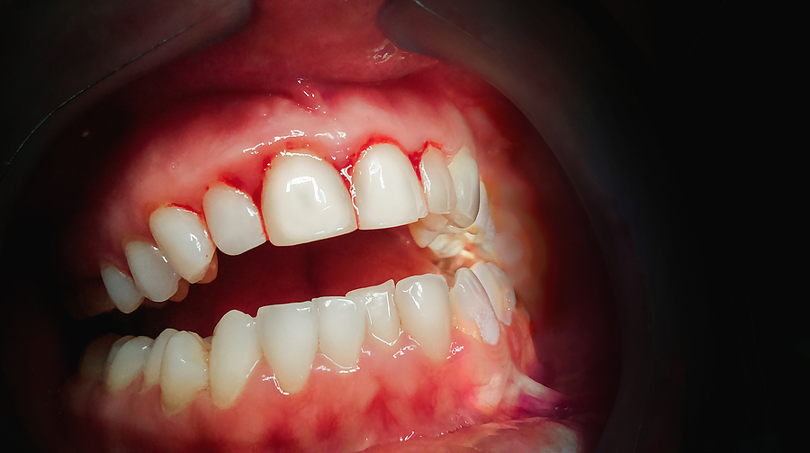 Comprehensive Guide to Gum Disease Treatment in Houston, TX