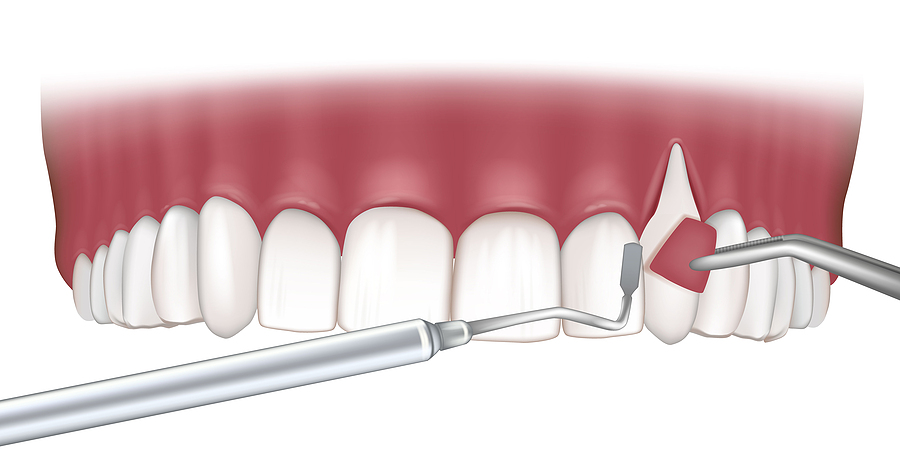 Restoring Your Smile: The Benefits of Gum Grafting in Houston, TX